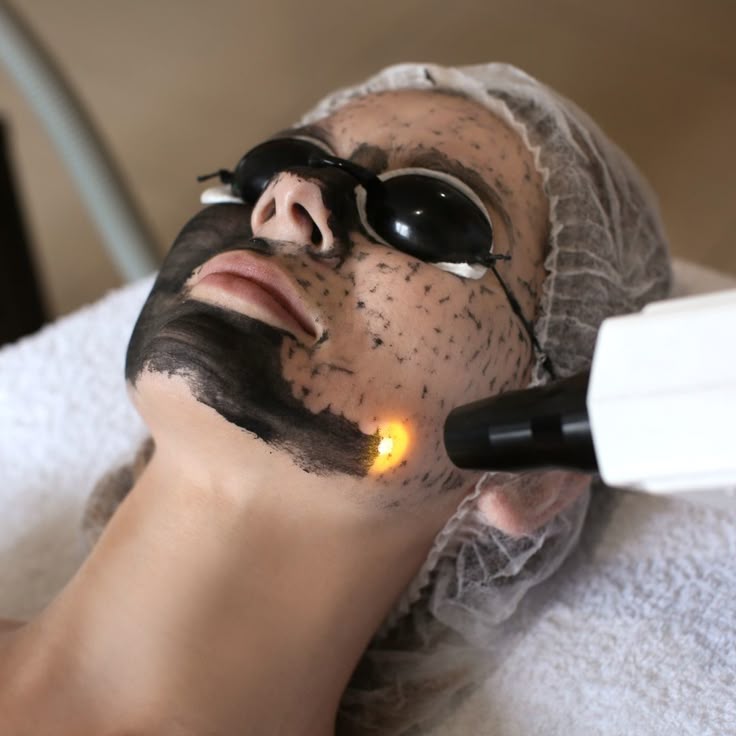 Carbon Laser Peel